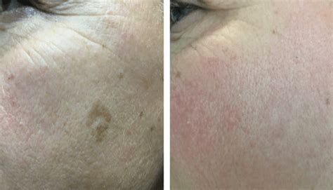 velashape vancouver|Pigmented Lesion Treatment Vancouver .
